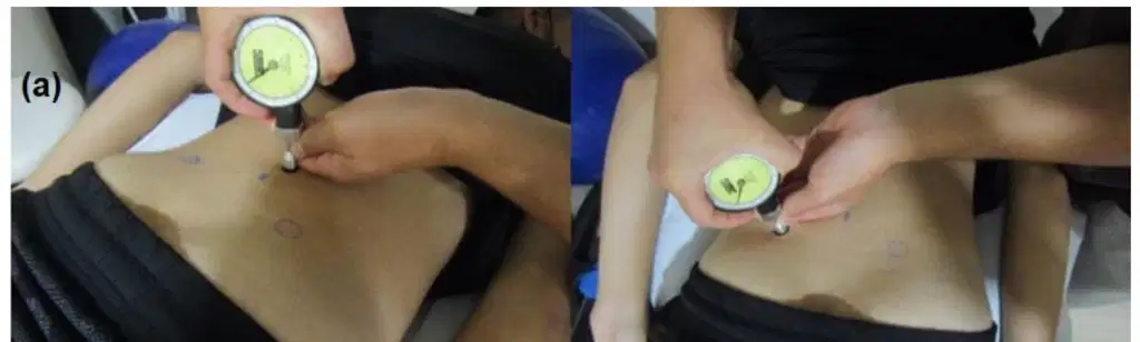 Transforming Rehabilitation: The Impacts of Dry Needling on Non-Specific Low Back Pain 1 Pressure pain threshold assessment