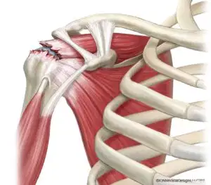 Illustration médicale d'une rupture de la coiffe des rotateurs montrant les tendons et muscles endommagés de l'articulation de l'épaule utilisée dans un article Kinvent sur l'évaluation des rotateurs de l'épaule